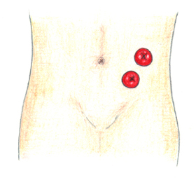 ߿(double-barrel colostomy)̹
