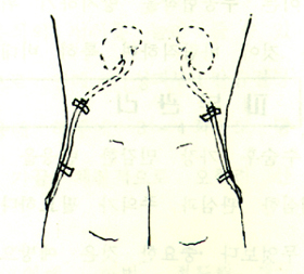 Ŵġ(nephrostomy)